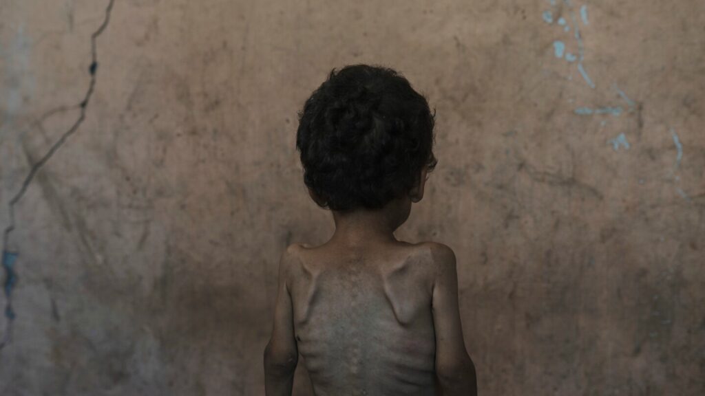 More than 54,600 young children in Gaza may be acutely malnourished, study finds